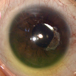Ectasia corneal iatrogénica y ojo seco: manejo con lentes esclerales free-form y modelo MIOP